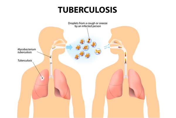 Tuberculosis