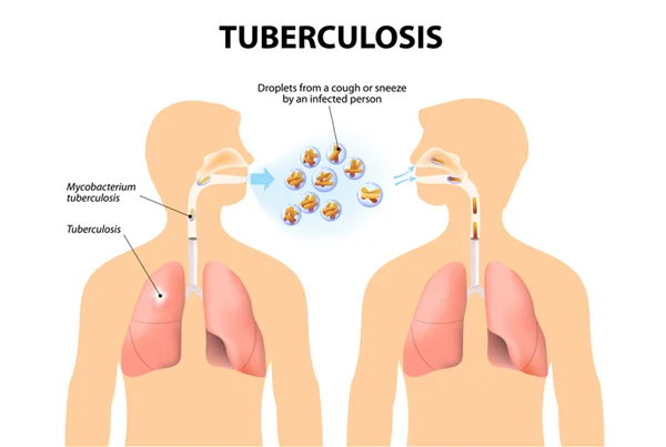 Tuberculosis
