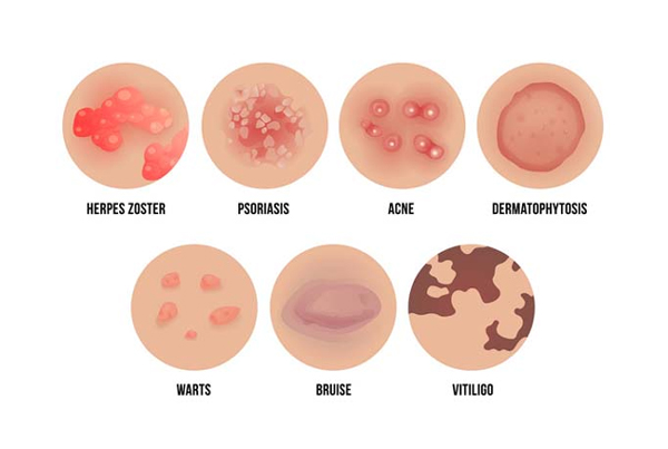 Skin Diseases